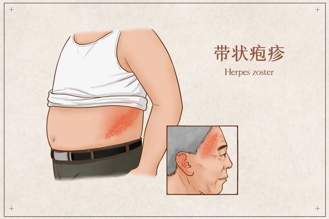 换季带状疱疹多发，接种疫苗远离“切肤之痛”