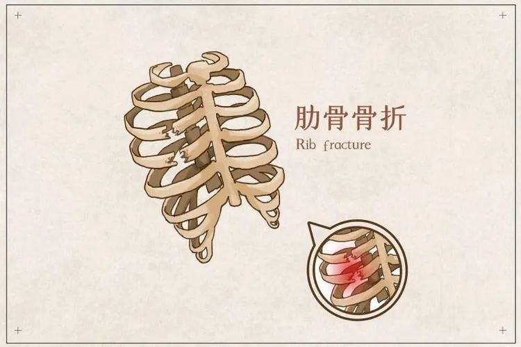 超声实现精准辅助，创伤也能快速康复——凤凰胸心外科常规开展肋骨骨折的微创手术技术