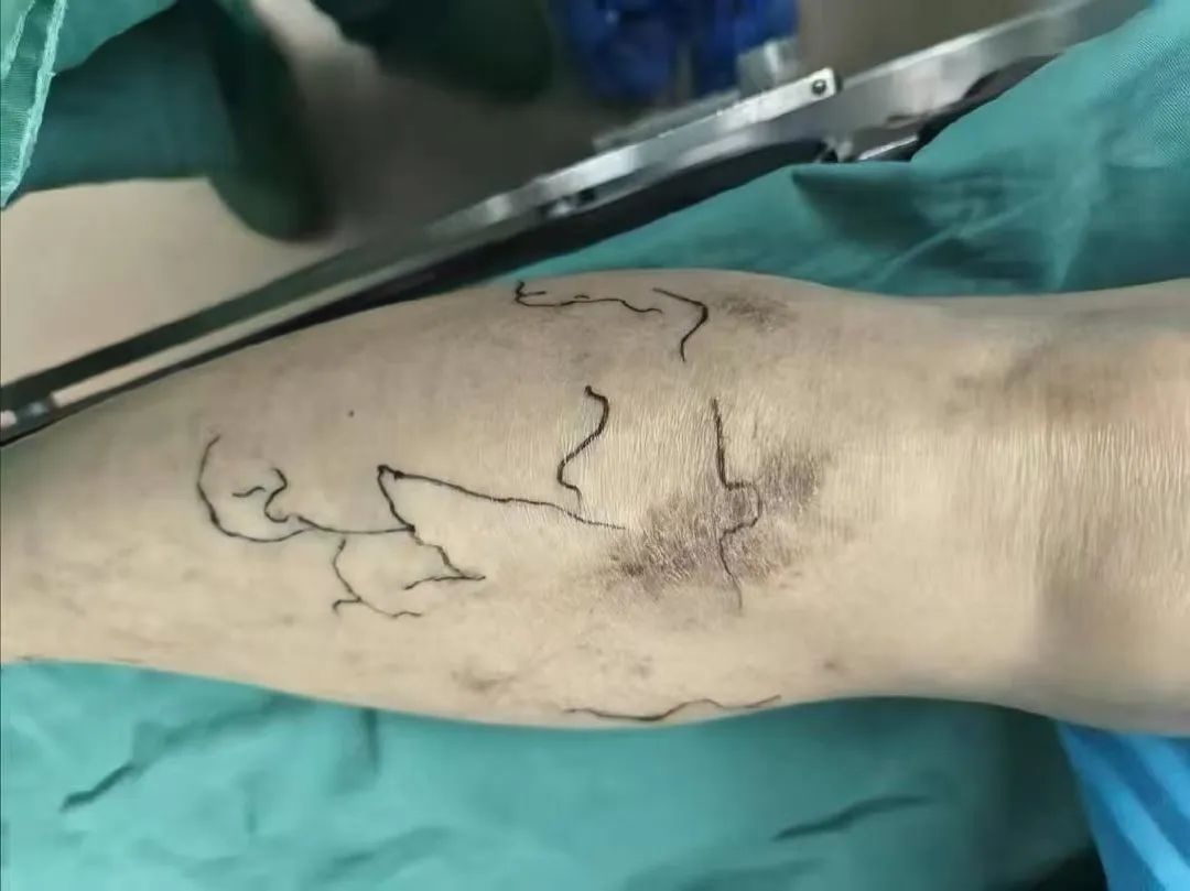 微创技术革新静脉曲张治疗，让健康轻盈回归