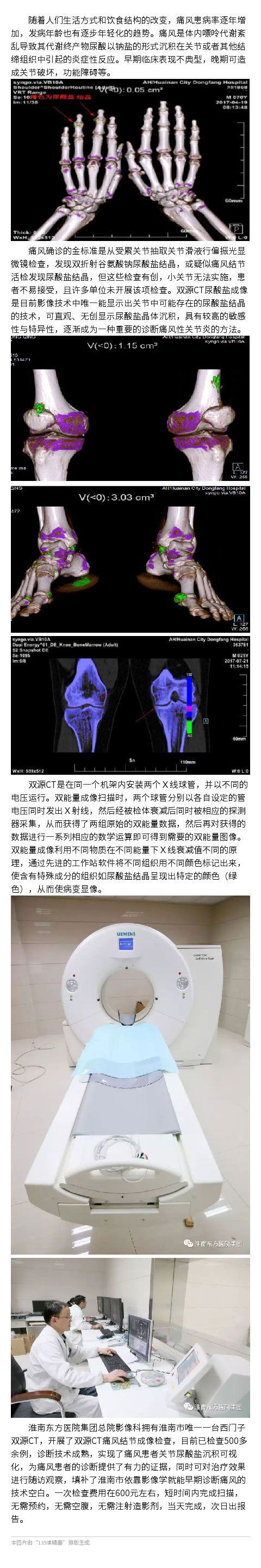 双源CT火眼金睛 洞察秋毫痛风元凶——双能量CT成像诊断痛风性关节炎